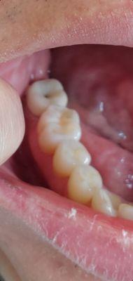 Crown was done poorly!