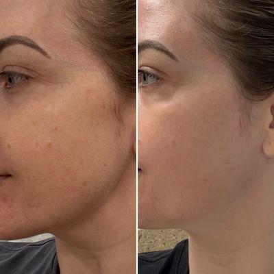 Results after 1 Fraxel session.