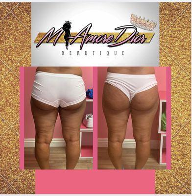 Non Surgical BBL
Rounder,perkier, lifted butt with no surgery or downtime.