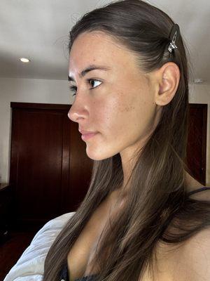 Side view (after surgery)