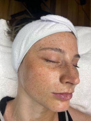 Dermaplaning with Medical Aesthetician Faith! Leaves skin exfoliated and hydrated.