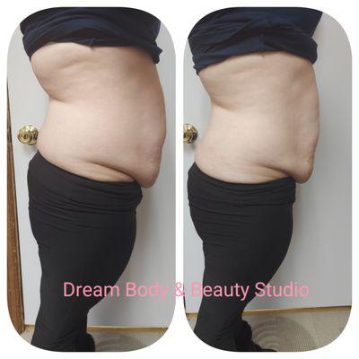 Results! We give you body goals. Just one body contouring session!