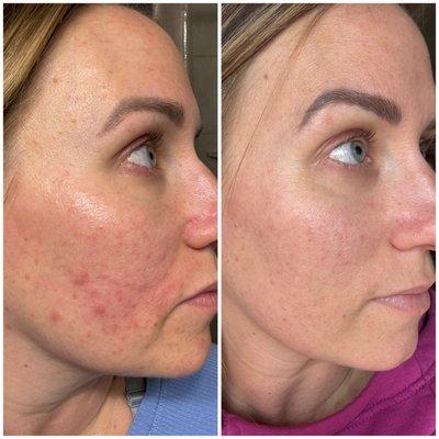 I had decent skin all my life and then I had two kids, stayed off birth control, turned 33 and had the worst acne of my life.