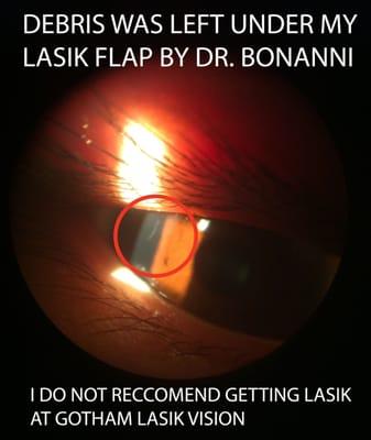 Debris left under my flap by Dr. Brian Bonanni.
I do not recommend this place for Lasik!