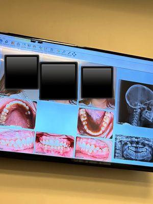 Here is my second child's initial photos before treatment started. You can clearly see the business highlighted.