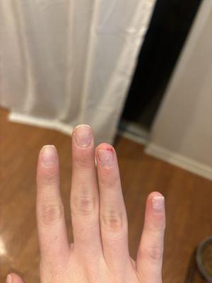 Nail injury