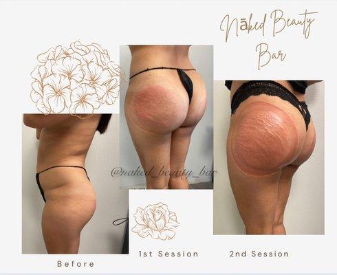 Natural Non Invasive BBL
Natural Butt Enhancements some with VacuumTherapy