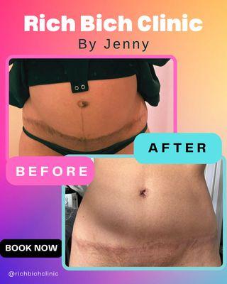 #surgicalscarring #beforeandafterscars #scarreivision Treated with the co2 laser