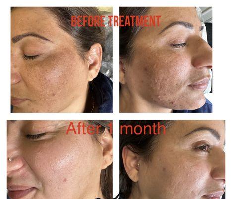 Melasma treatment