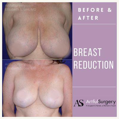 Elizabeth S Lee, MD, FACS - ArtfulSurgery