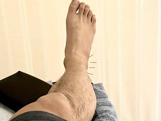 Sprained ankle treatment
