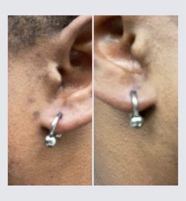 Initial earlobe piercing with the full intent to stretch! ASTM F-136 titanium horseshoes.