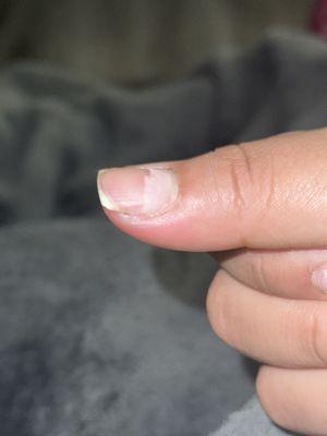 Infection starting to grow on cuticle.