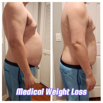 Medical weight loss with Semaglutide