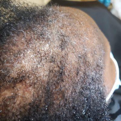 Severe hair loss