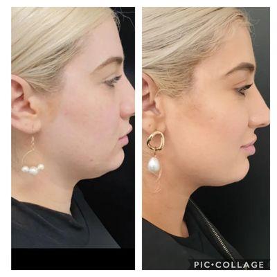 Double chin reduction through Lipo Dissolve and Cryo Fat Freezing