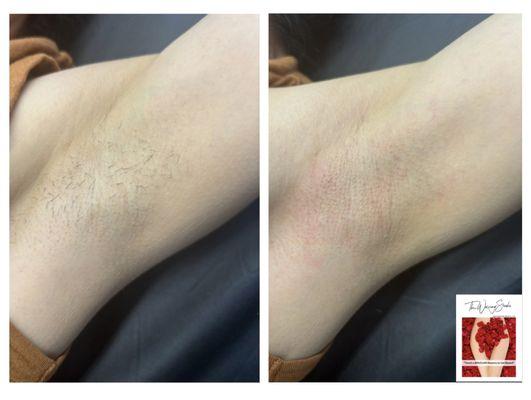 Underarm Wax - immediate results
(redness is normal right after)