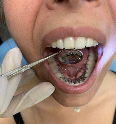 Lingual braces hidden behind the teeth