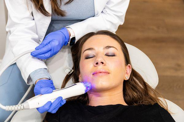 Virtue RF Microneedling produces a far superior result to traditional microneedling and pens