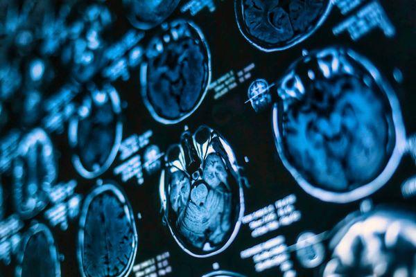 Achilles Neurology Clinic Beverly Hills