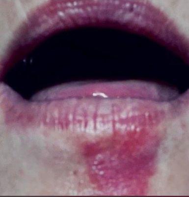 My bad cold sore
