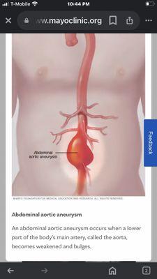 Abdominal Aortic aneurysm