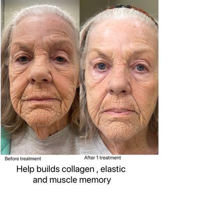 After 1 treatment INCREDIBLE