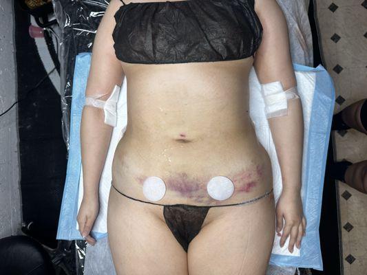 Post operative Lymphatic massage after lipo 360