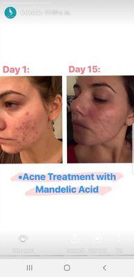 Tratamiento de acné con ácido mandelico.