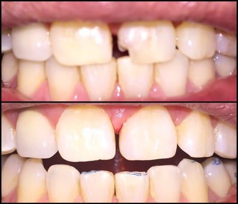 Chipped teeth happen to all of us. Bonding can be quick, easy, painless and affordable!