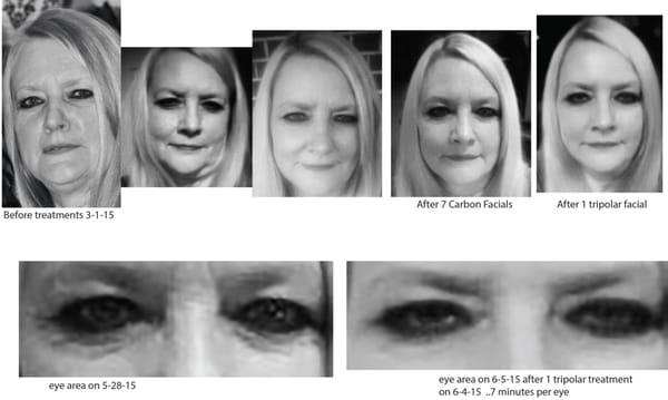 Carbon facial with the a light microdermabrasion which is followed by application of a special cream containing volcanic ash...