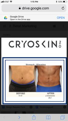 Our new Cryoskin 2.0! Immediate Results: Naturally Removes Fat, Tightens Skin and Eliminates Cellulite!