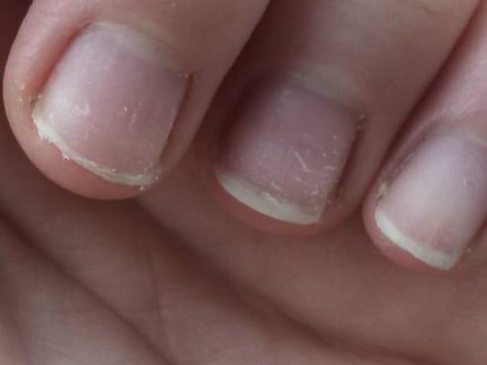 my chewed up nails after I had to have somebody take off what Kim did to me. they couldn't get it all off. I cried
