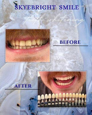 BRiGHT service
Before: Shade 28
After: Shade 10