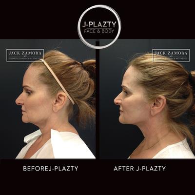 J-Plazty Face - ideal for loose and lax skin on the neck, jowls, and jaw.