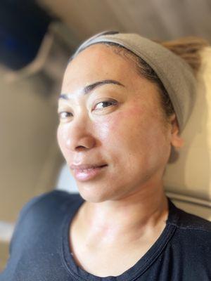 Microneedling with exosome