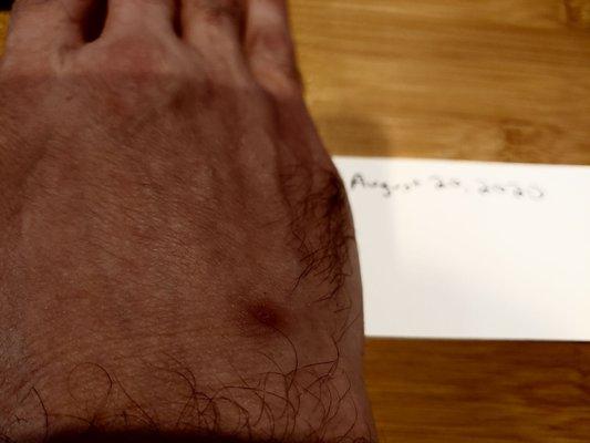 Scar from abscess caused by Dr. Zhou's not using proper sterile technique during needle insertion.