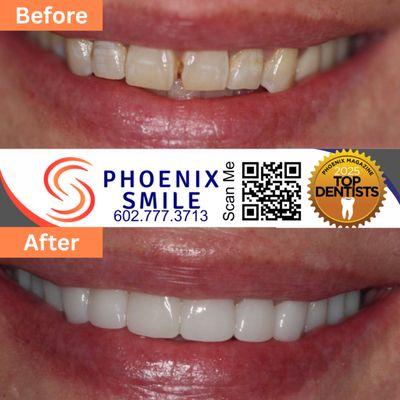 Cosmetic Dental Veneers