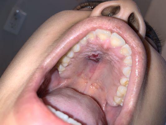 Fifth day ER gave me Antibiotics and a special mouthwash