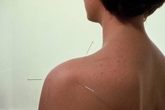 Acupuncture works!