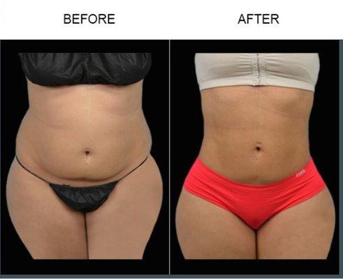 Tampa Liposuction by Bassin