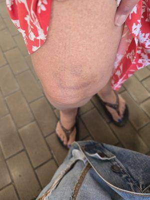 Bruises from the encounter with the brute