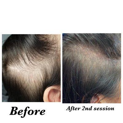 Scalp Pigmentation is a method of tattooing which stimulates follicles resulting in a thicker more youthful looking head of hair.