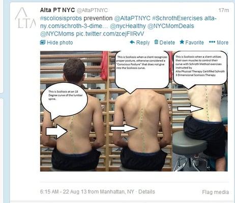 Schroth Scoliosis Treatment and patient education. http://t.co/cCuuXBHmO4