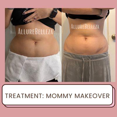 Our non-surgical treatment focuses on the stomach, sides, and full back. You will see same day results and final results within 3-6 days.