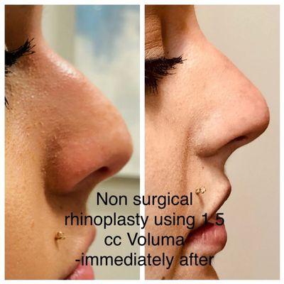 Before & After non surgical rhinoplasty using filler.