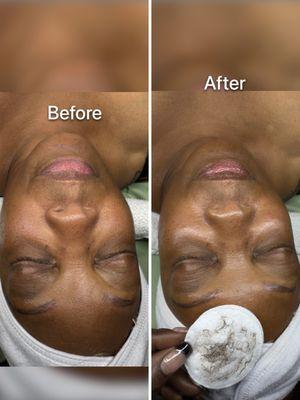 Dermaplane Facial