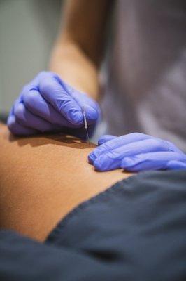 Functional Dry Needling