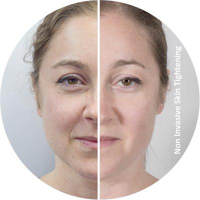 Laser Wrinkle Reduction @LaserHariRemoval.studio