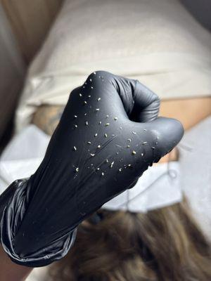 Extractions with every facial